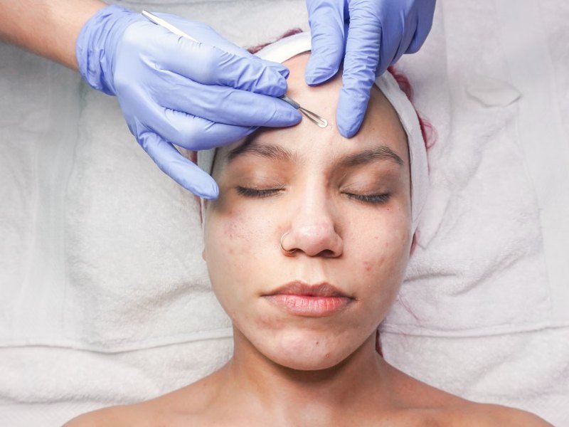 Esteticista fazendo dermaplaning com lâmina no rosto da paciente