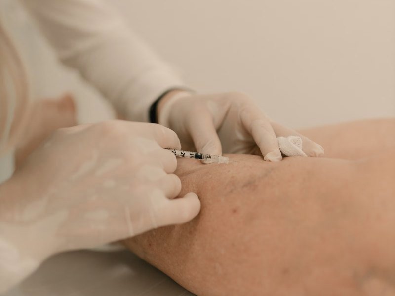 Aplicação para remoção de vasinhos na perna